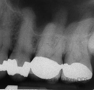 Maxillary Molar