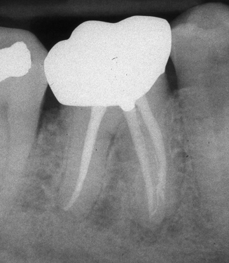 apical bifidity